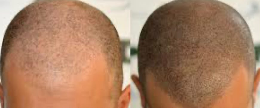 Antes y después de micropigmentación capilar